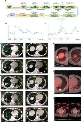 Case Report: Pseudoprogression With Nivolumab and Bevacizumab Followed by Recurrent Immune-Related Pneumonitis in Urothelial Carcinoma With Lung Metastasis